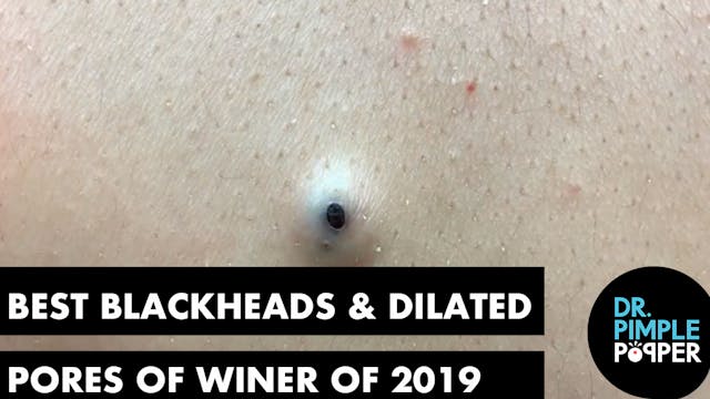 Best of Blackheads 2019 