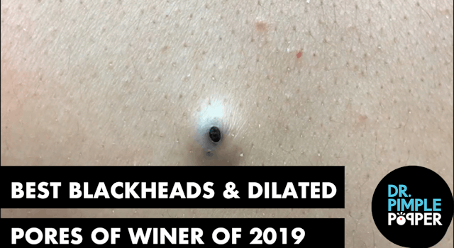 Best of Blackheads 2019 