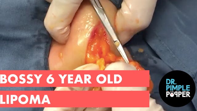 The Bossy 6 Year Old Lipoma