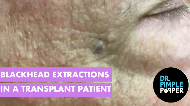 Blackheads extracted in a transplant ...
