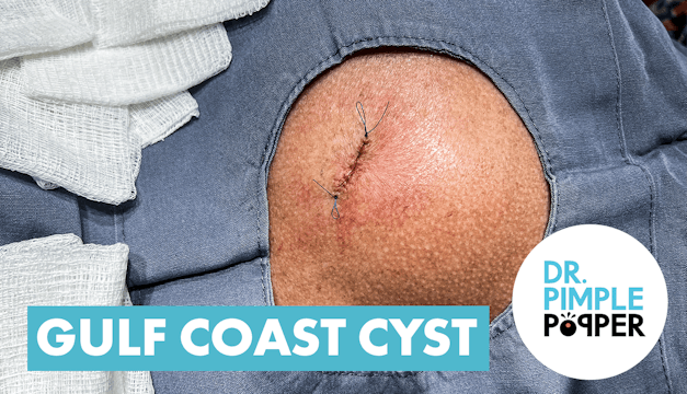 Dr Pimple Popper Opens The 'Gulf Coast' Cyst