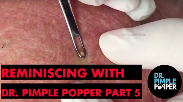 Reminiscing with Dr Pimple Popper: Pa...