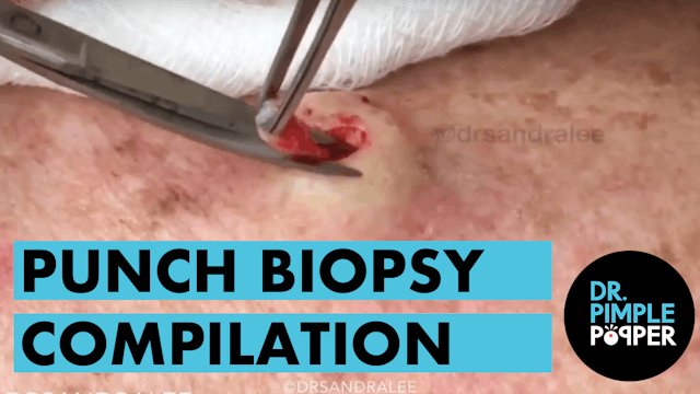 Punch Biopsy Compilation: The Best Cysts and Blackheads Extracted