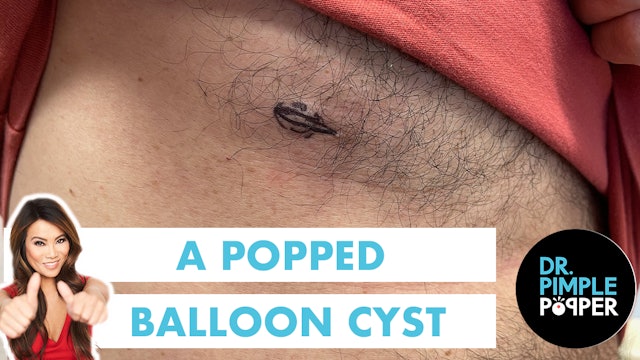 A Popped Balloon Cyst