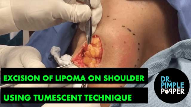Excision of a Large Lipoma on the Sho...