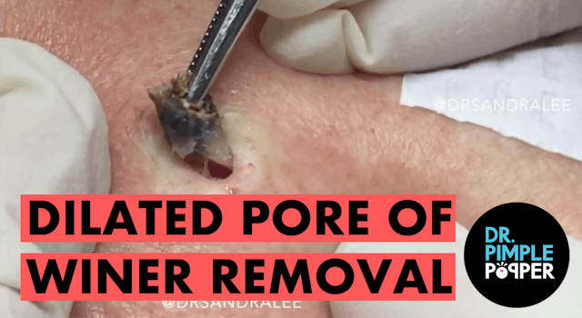 Stitching a "hole" made by a dilated Pore of Winer