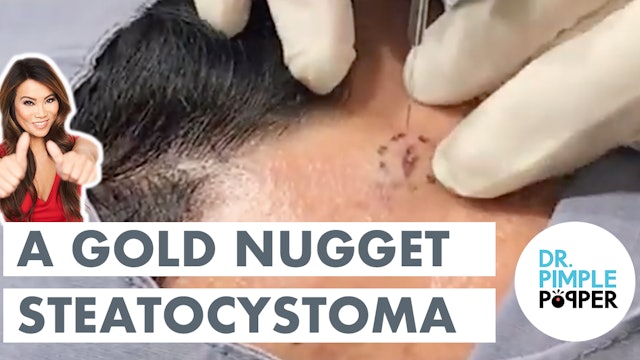 A Gold Nugget Steatocystoma