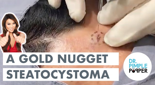 A Gold Nugget Steatocystoma