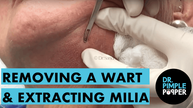 Removing a Wart+Extracting Milia