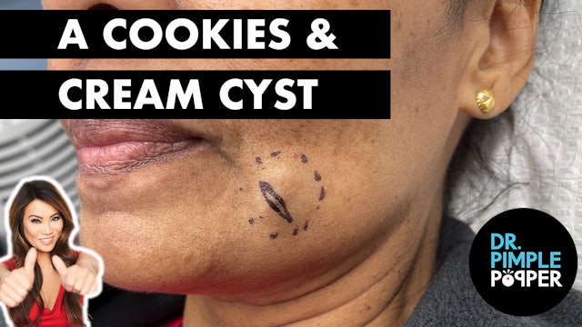 Cookies & Cream Cyst