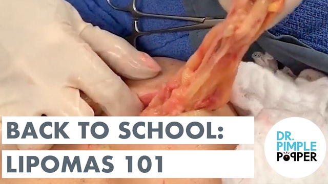 Back to School with Dr. Pimple Popper: Lipomas 101