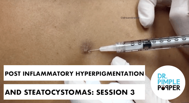 Post Inflammatory Hyperpigmentation (PIH) and Steatocystomas Session 3