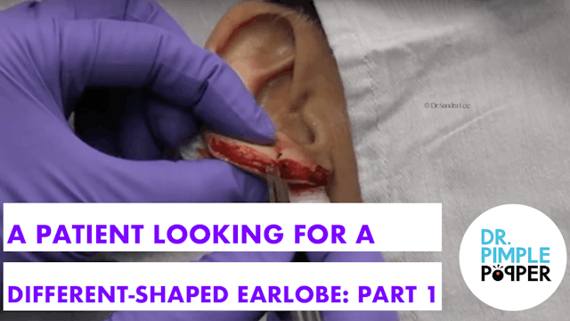 A patient looking for a different shaped Earlobe found Dr Pimple Popper! Part One