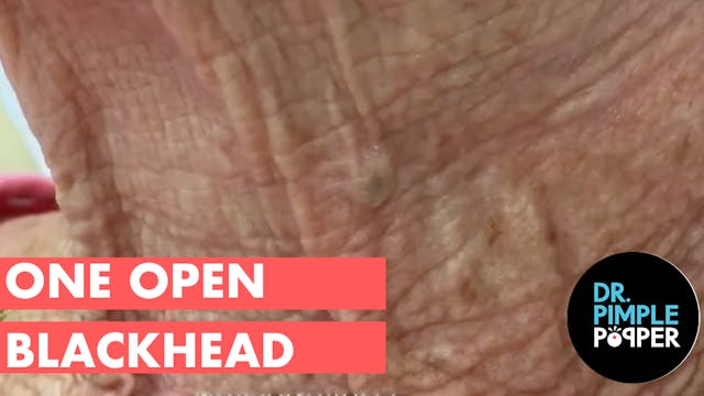 One open blackhead