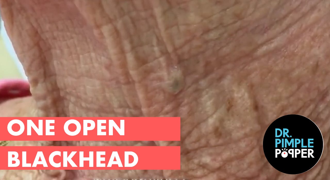One open blackhead Dr. Pimple Popper