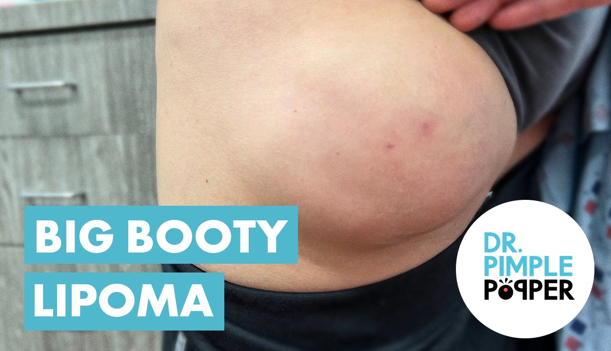 A Cheeky Butt Lipoma - Recently Added - Dr. Pimple Popper