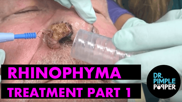 Rhinophyma Treatment (Session 1)