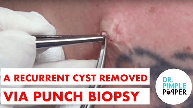 A Recurrent Cyst Removed with Punch B...