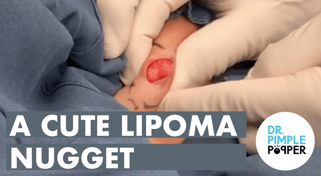 An Extra Big Booty On The Back Lipoma Love Dr Pimple Popper