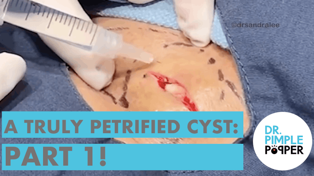 Truly Petrified Cyst (Part 1)