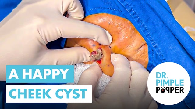 A Happy Cheek Cyst