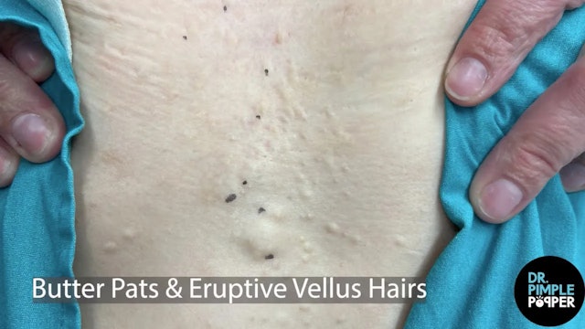 Mining For Butter Pats & Eruptive Vellus Hairs