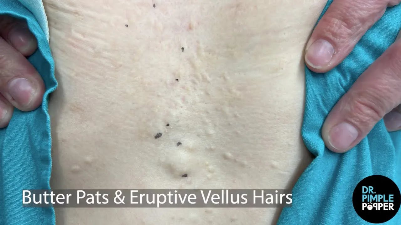 Mining For Butter Pats & Eruptive Vellus Hairs Dr. Pimple Popper
