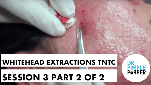 Whitehead Extractions TNTC, Session 3...