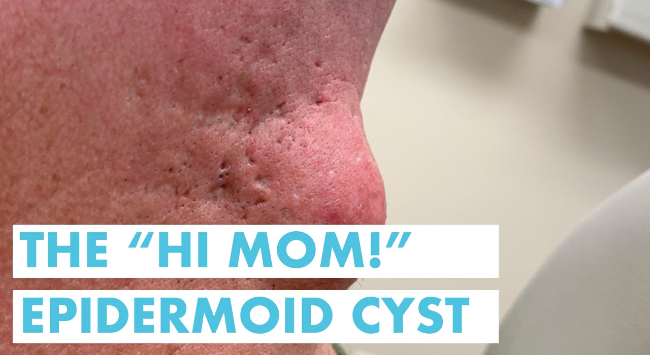 The "Hi Mom!" Epidermoid Cyst Recently Added Dr. Pimple Popper