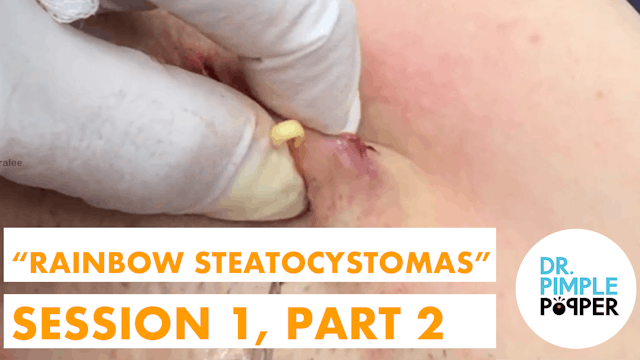 Rainbow Steatocystoma Multiplex: Session1, Part 2