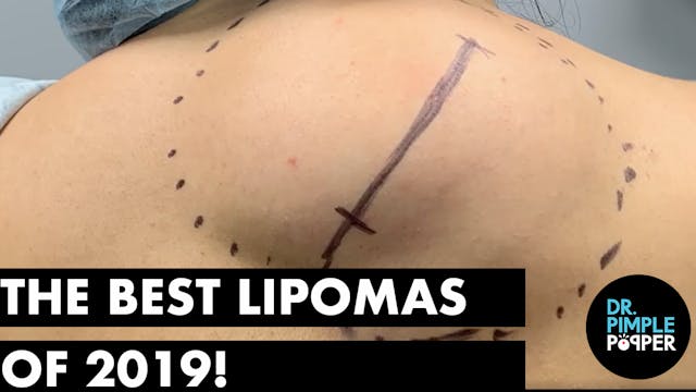 The Best Lipomas of 2019!