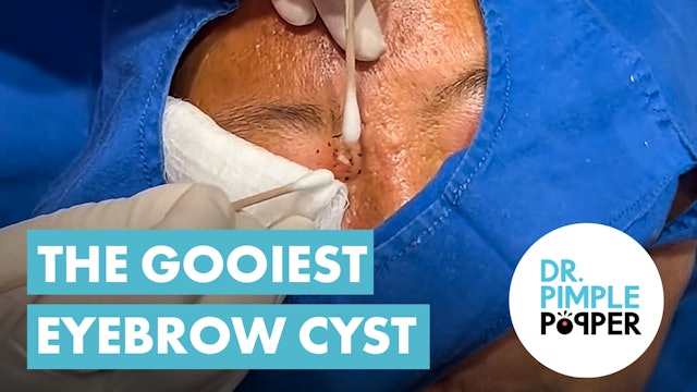 The Gooiest Eyebrow Cyst