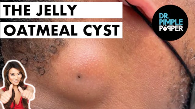 The Jelly Oatmeal Cyst 