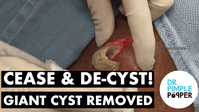 Cease & De-CYST! Special (Part 1)