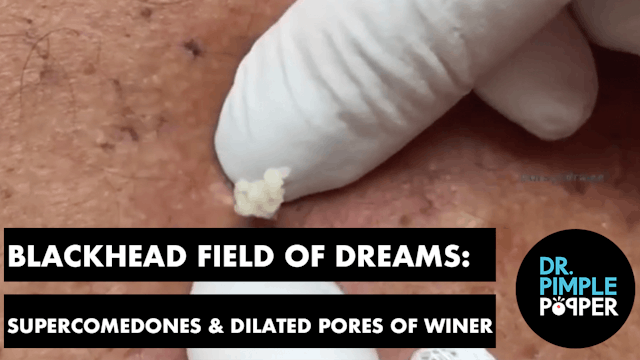 Blackhead Field of Dreams: Supercomed...