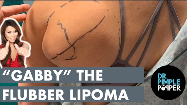 "Gabby" the Flubber Lipoma 