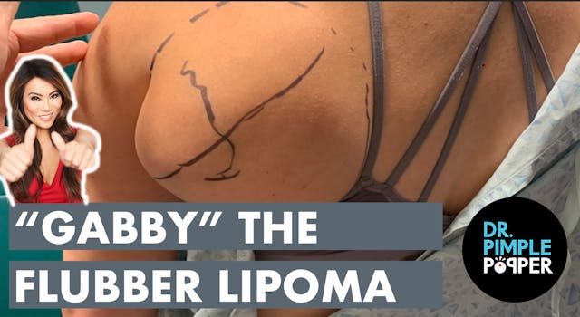 "Gabby" the Flubber Lipoma 