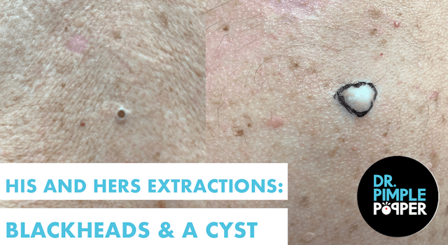 His and Hers Extractions: Blackheads & A Cyst