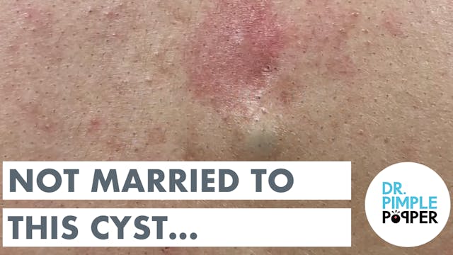 Not Married to this Cyst