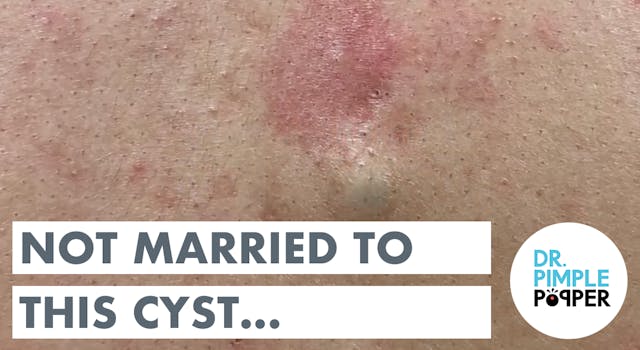 Not Married to this Cyst