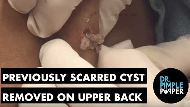 Previously Scarred Cyst Removed on Up...