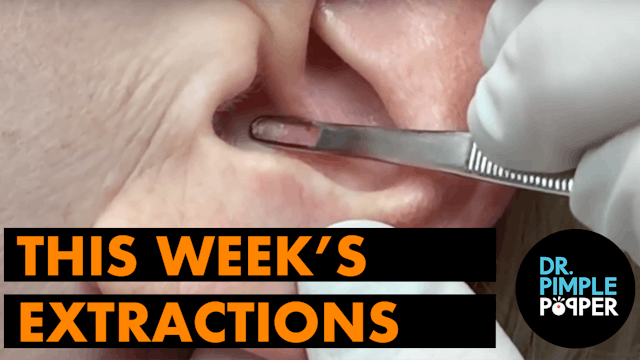This Weeks Extractions!