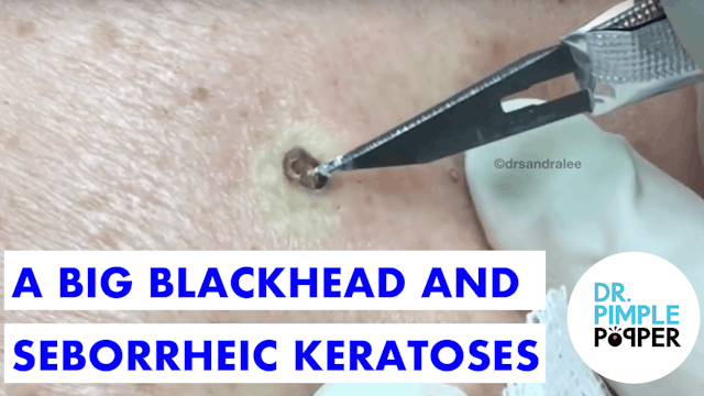 A Big Blackhead & Some Seborrheic Keatoses