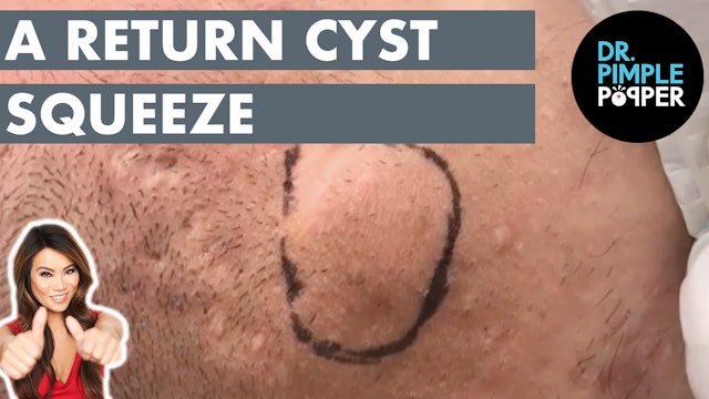 A Return Cyst Squeeze on the Neck