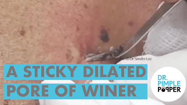 A Sticky Dilated Pore of Winer