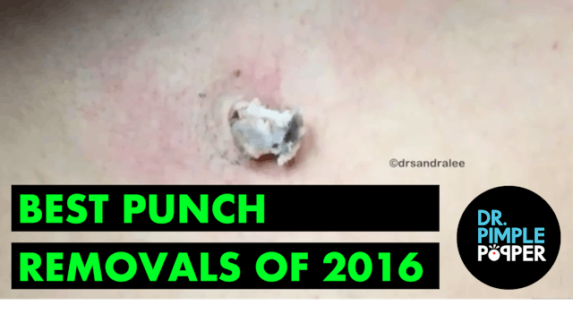 Dr Pimple Popper's Best Punch Removals of 2016