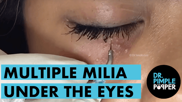 Multiple Milia Under the Eyes