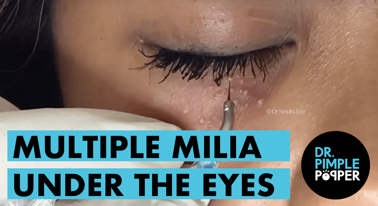 Milia Under the - Dr. Pimple Popper