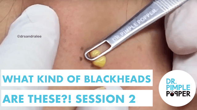What kind of BLACKHEADS are these?! S...