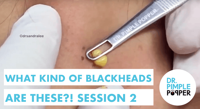 What kind of BLACKHEADS are these?! Session 2